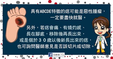 痣好壞|我的「痣」會是惡性腫瘤嗎？醫師告訴你：符合這5特。